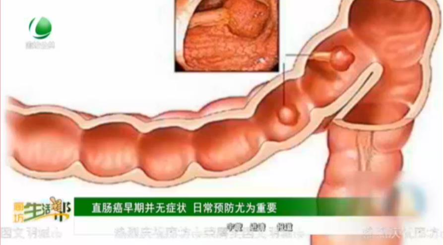 直腸癌早期并無(wú)癥狀 日常預(yù)防尤為重要